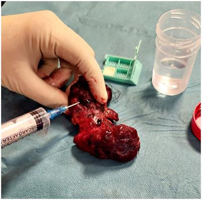 Enhancing diagnostic precision in thyroid nodule assessment: evaluating the efficacy of a novel cell preservation technique in fine-needle aspiration cytology